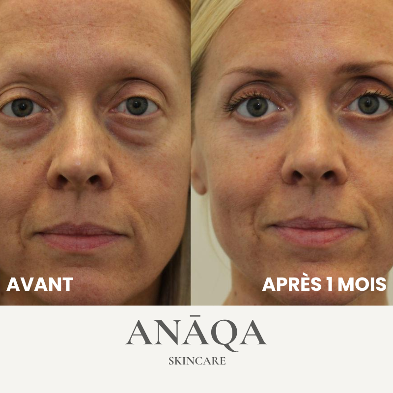 Microneedling Anti-Dark Circles Patch