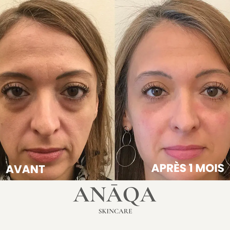 Microneedling Anti-Dark Circles Patch